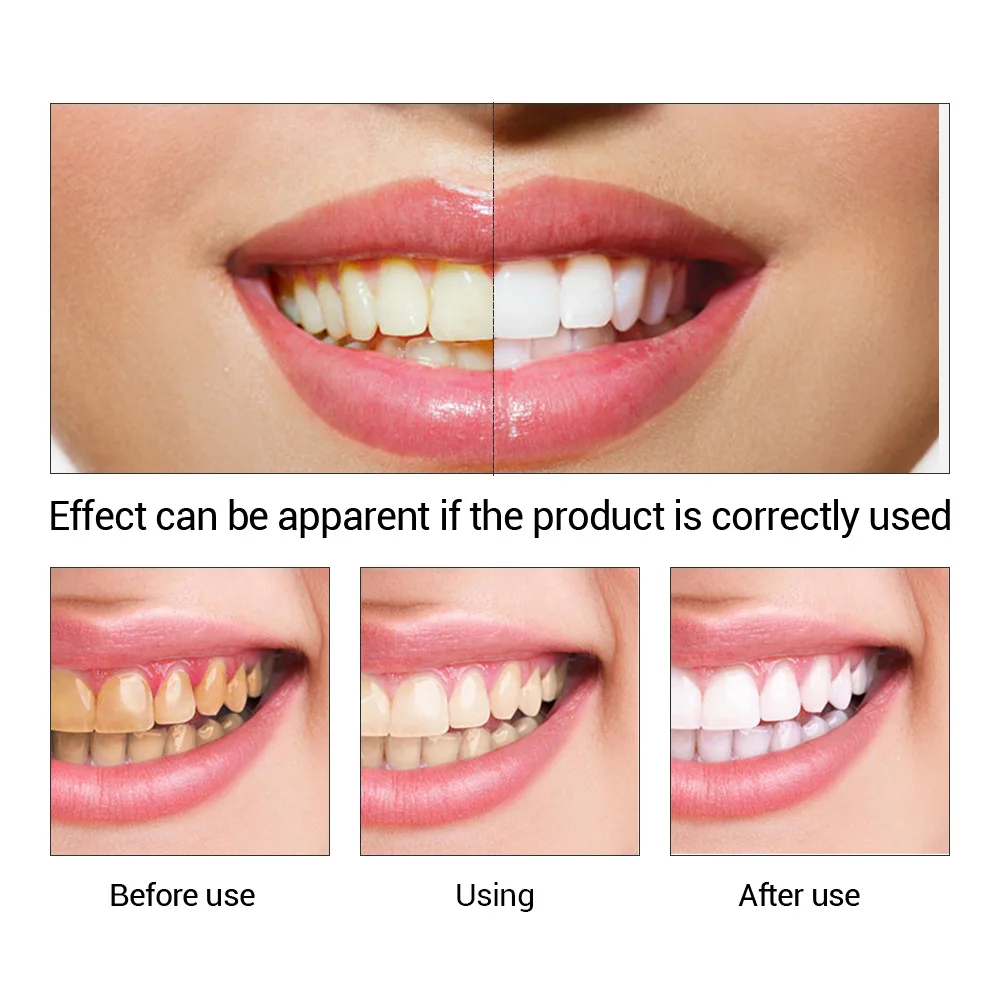 FTEENPLY Sbiancamento Dei Dent - Teeth Whitening Near Me recensione e prezzo